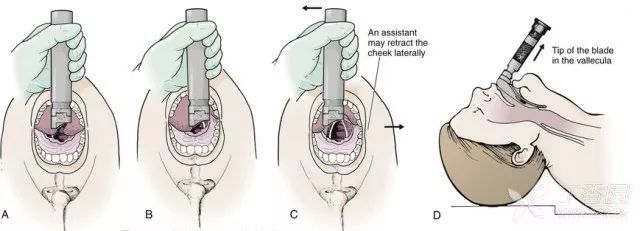 气管插管技术及医护配合
