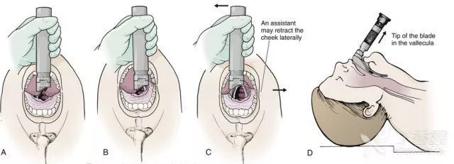 氣管導管,從患者右側口角將導管沿鏡片插入,斜口端對準聲門送入氣管內