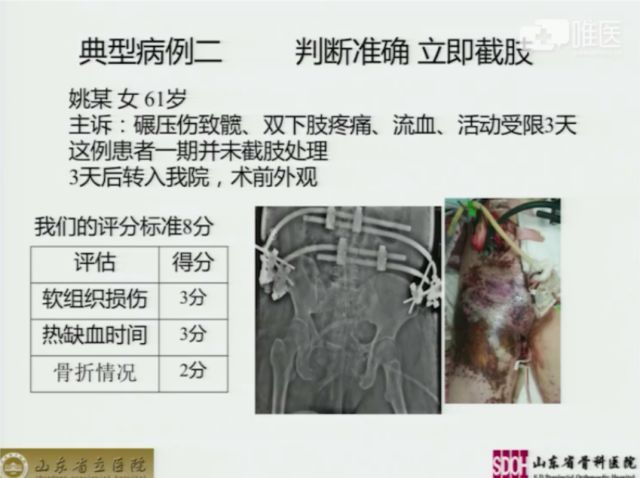 周东生:髋部软组织严重损伤的早期处理策略