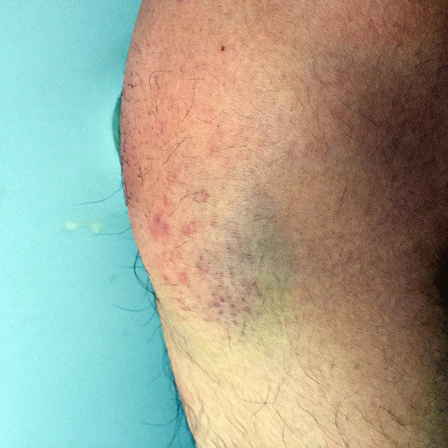 广州男子第一次打野战膝盖淤青腿起包