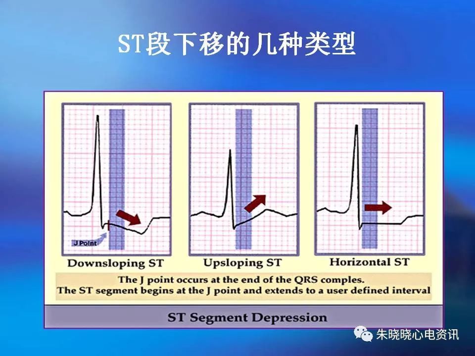 3,病理性q波,st段弓背抬高,st段壓低及t波的演變是心肌梗死心電圖定性