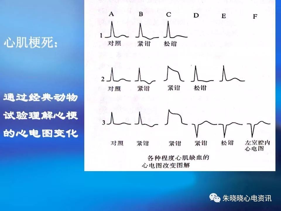 心肌梗死的心电图特点(ppt)