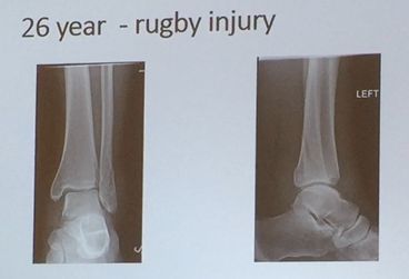 AAOS 2018:踝关节骨折后到底什么时候负重?