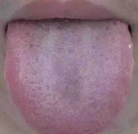 舌头,一旦出现这个信号,马上找中医!