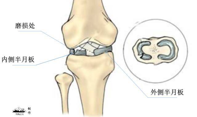 緩衝關節震動和保護膝關節的主要部位,行走中膝蓋最容易發生的軟骨