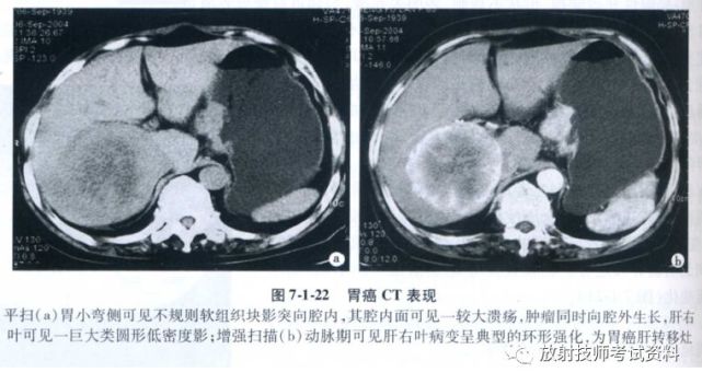 技考17 Ct Mr影像诊断基础 消化系统