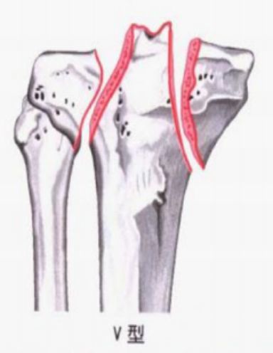 骨科精读 下肢骨折常用分型大全 果断收藏 腾讯新闻