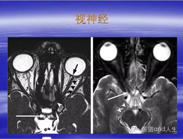 mri图像中可以看到的八条颅神经