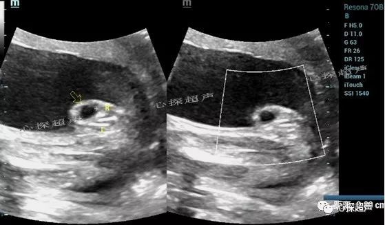 显示女性外阴右侧大阴唇囊性团块.