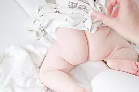 【母婴】宝宝反反复复红屁股，到底是不是纸尿裤的“锅”？