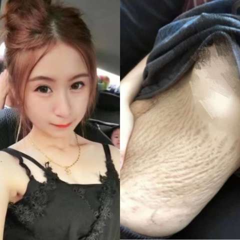 19岁美女生完四胞胎后,肚子直接变成了这样,太不忍直视了