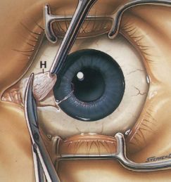 垂直剪除复有一部分菲薄结膜的翼状胬肉颈部和头部(h) ▼5.