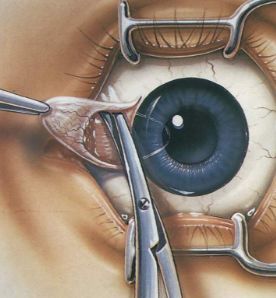 翼状胬肉的体部(b)在菲薄的结膜下被分离到半月皱襞.