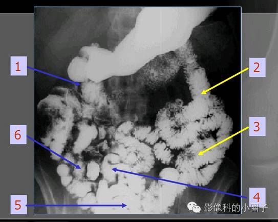 小肠ct分段解剖图图片