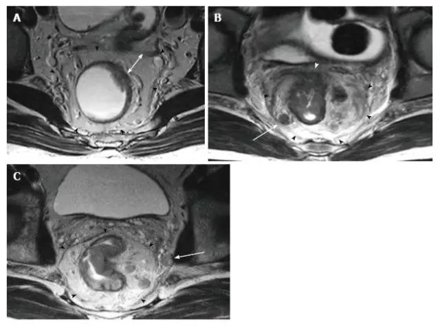 最详细直肠癌mrl诊断指南一图看懂