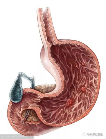 胃息肉一定要手术吗?