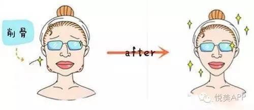 下巴|下颌角磨骨，给你从U到V的迷人小脸