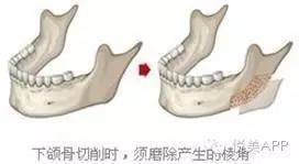 下巴|下颌角磨骨，给你从U到V的迷人小脸