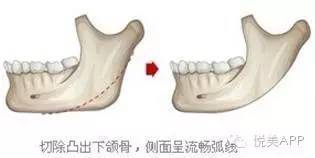 下巴|下颌角磨骨，给你从U到V的迷人小脸