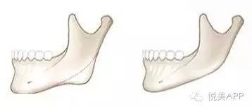 下巴|下颌角磨骨，给你从U到V的迷人小脸