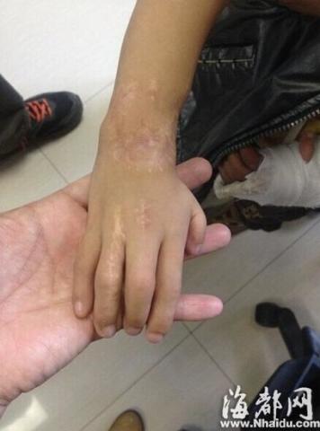 五岁男童手腕内翻似永远在拥抱