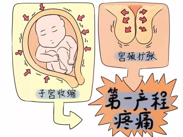 分娩镇痛大揭秘:生娃到底有多痛?