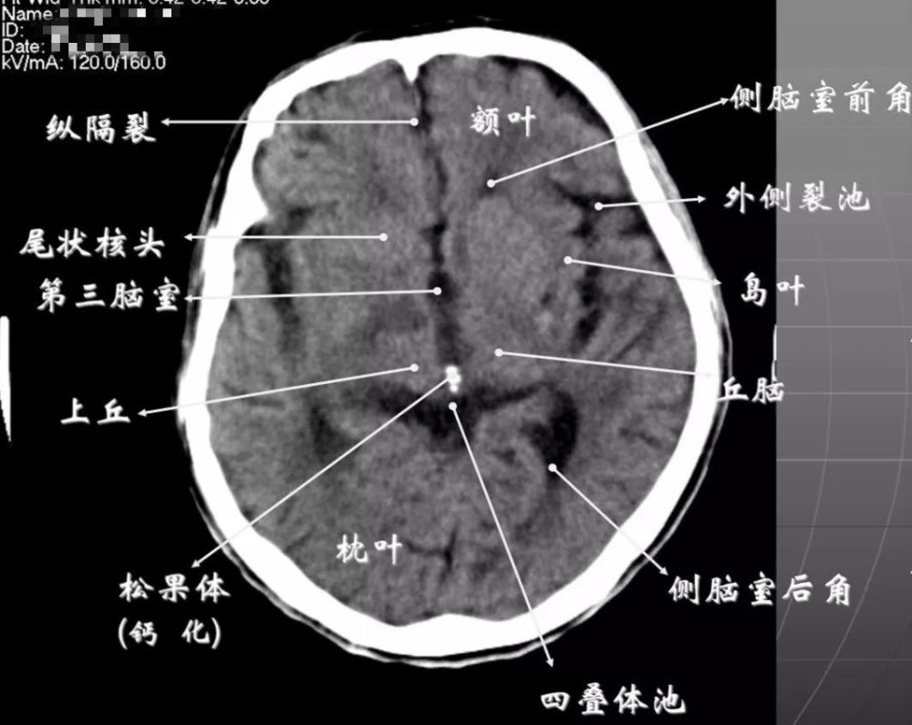 大脑交叉池图片