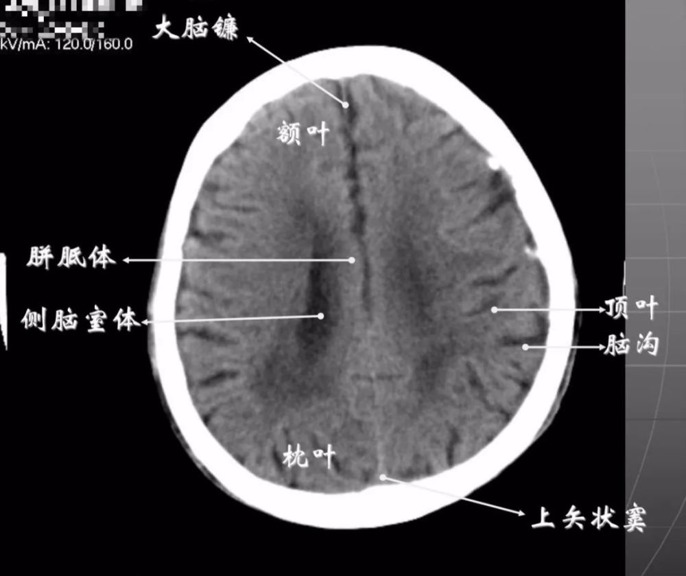 7大脑皮质下部层面(半卵圆中心层面)在胼胝体和侧脑室上方,大脑镰自前