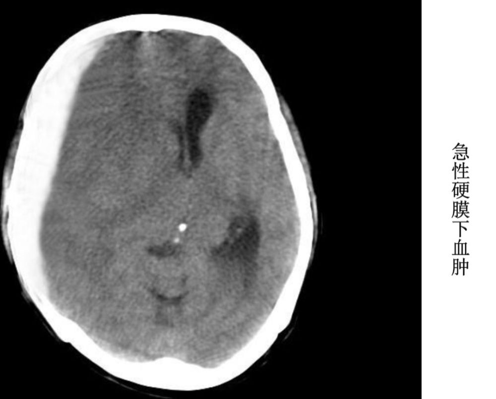 4脑梗死按解剖部位可分为:大脑梗死:大梗死---超过一个脑叶,5cm以上