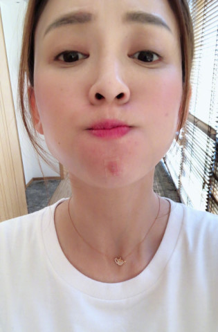 陈乔恩再次微博上晒自己长痘痘的照片,网友调