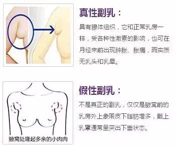 副乳不仅仅是1坨 肉肉 出现这4种情况 必须手术 乳腺癌 手术 乳腺