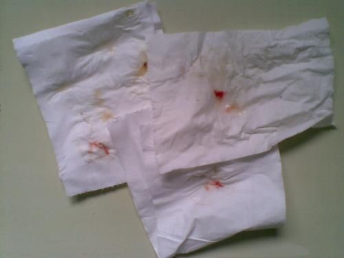 虽然早期肺癌基本上没有症状,但突然出现的痰中带血无论如何都应该做