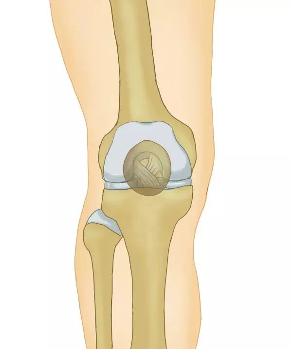 蹊跷的骨挫伤 没有骨折的骨折 骨挫伤 膝关节 骨关节炎