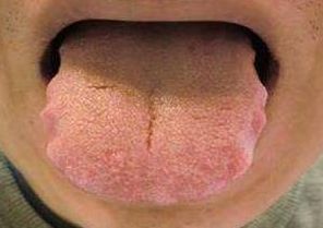 气虚,怎么补气都除不掉的齿痕舌,问题到底出在哪?