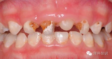 朋友带着孩子去看了牙科,医生却反过来说了朋友一顿:不一定吃糖才会有