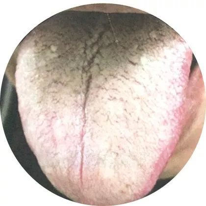 最全高清舌诊图谱,堪比教科书,必须收藏!