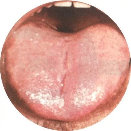高清舌診圖譜(值得收藏)_騰訊新聞