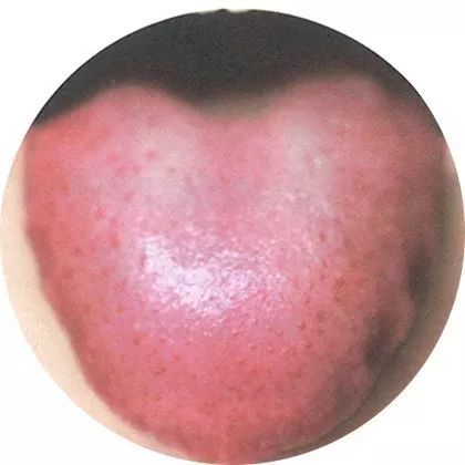 舌质:略干舌苔:偏薄舌色:深红此舌象提示痰阻血瘀,肺肾阴虚,内火偏旺.