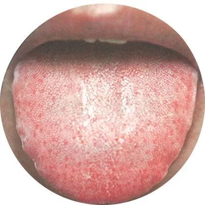 最全高清舌诊图谱,堪比教科书,必须收藏!