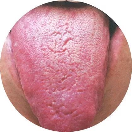 最全高清舌诊图谱,堪比教科书,必须收藏!