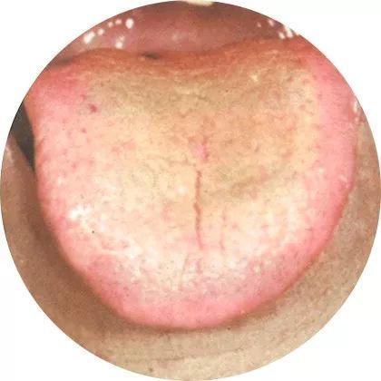 舌苔:黄灰色,厚腻舌质:暗淡舌体:有裂纹临床上,此类患者多有不思饮食