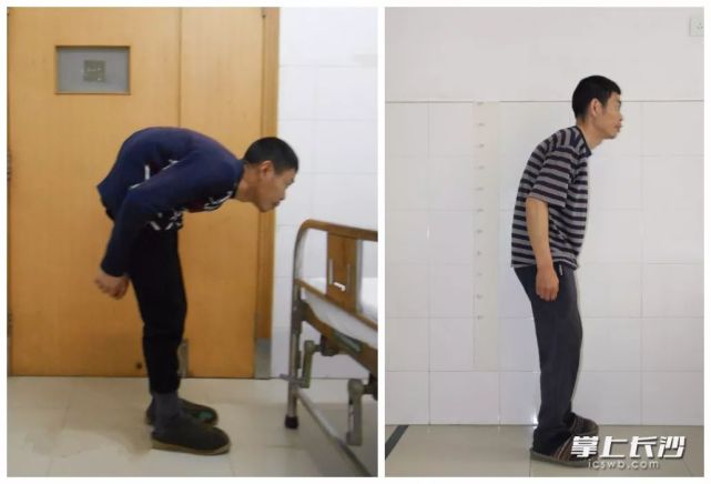 男子90度驼背走路脸朝地 手术后20多年来首次挺直腰杆