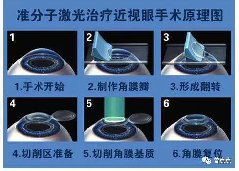 眼睛激光原理是什么_激光是什么样子图片(2)