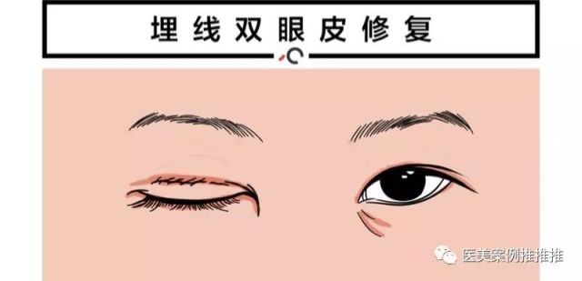 常见的双眼皮修复-腾讯网