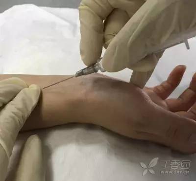 股动脉采血多用直刺法,针头与皮肤呈 90° 进针.