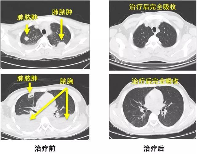 22岁小伙全身严重感染 爱喝饮料的年轻人要注