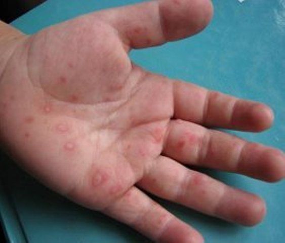 这种病5-7月是爆发期,婴幼儿最易感染,危及心脑可致命