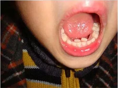 6岁女孩长出两排牙齿 原因让家长后悔不已