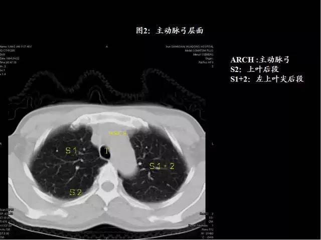 80張圖學會肺ct分段及典型疾病影像