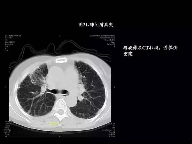 80張圖,學會肺ct分段及典型疾病影像